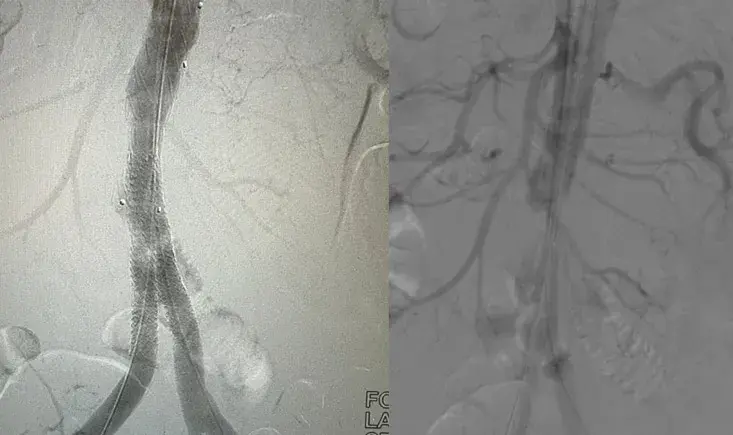 Sub occluding aortic thrombosis with claudication pain 