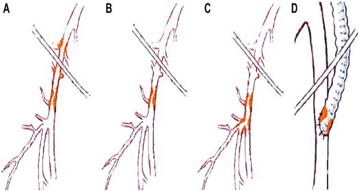 Azéma L. et al. EJVEVS, 41, 6 : June 2011 ; 787-793