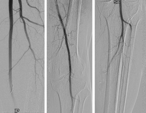 Treatment deep femoral artery