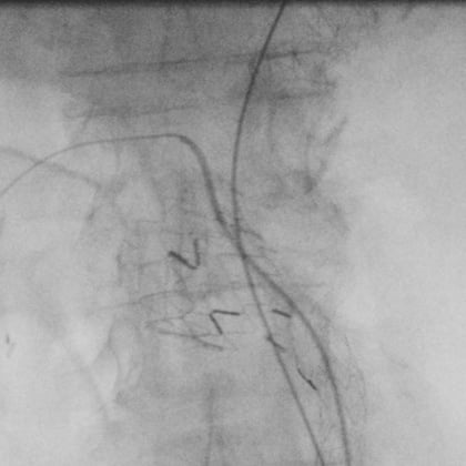 Catheterism of 2 renals arteries and SMA possible : Let’s insert the FEVAR!