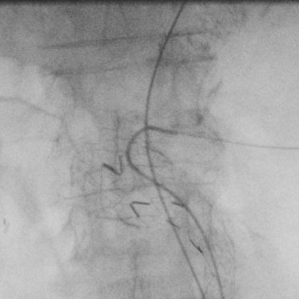 Catheterism of 2 renals arteries and SMA possible : Let’s insert the FEVAR!