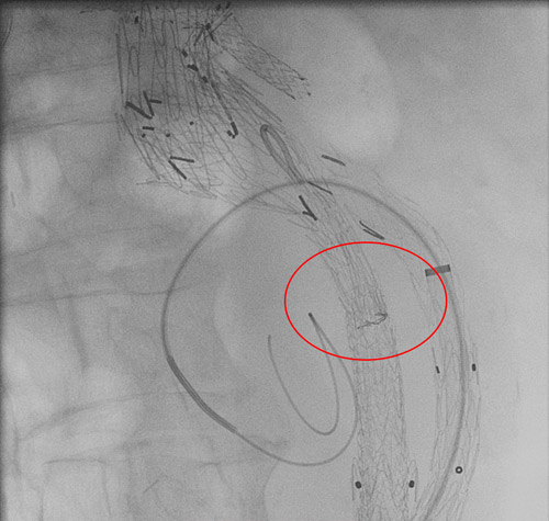 Impossibility to catheterise controlateral leg deployed in the old endoprothesis leg 