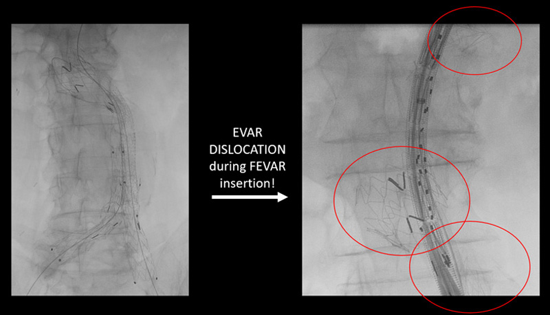 EVAR dislocation during FEVAR insertion!