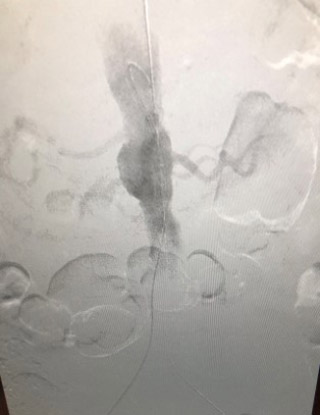 Acute limb ischemia: procedure