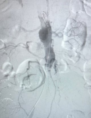 Acute limb ischemia: procedure