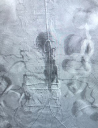 Acute limb ischemia: procedure