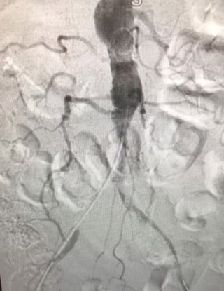 Acute limb ischemia: procedure