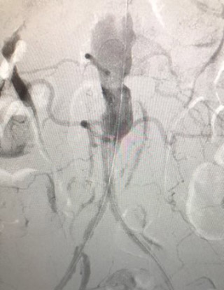 Acute limb ischemia: procedure