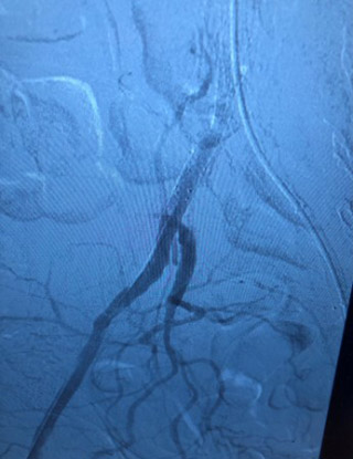 Acute limb ischemia: procedure