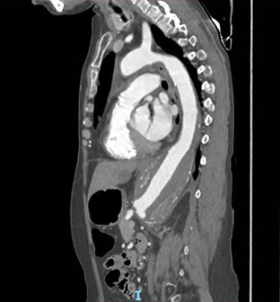 Progressive large aneurysm (67 mm) of the type IV thoraco-abdominal aorta (TAAA)