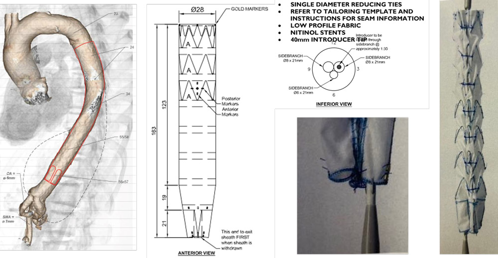 Custom-made triple-branched endovascular graft