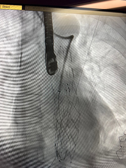 Trans-apical access by anterior thoracotomy 