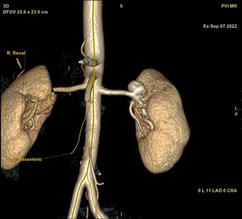 Aneurysm characteristics