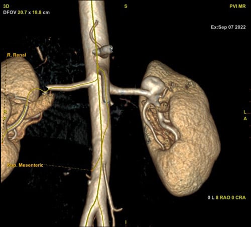 Aneurysm characteristics