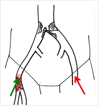 Stenting of the right common femoral artery by cross over