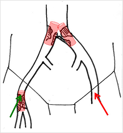 Iliac kissing stent