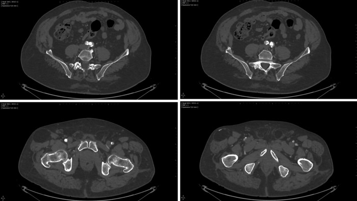 CT angiography