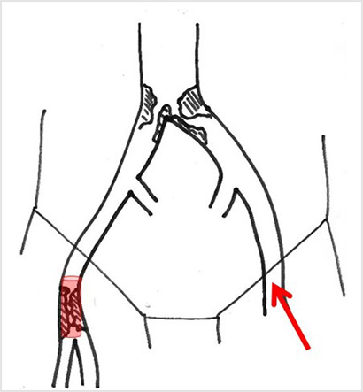 Stenting of the right common femoral artery by cross over