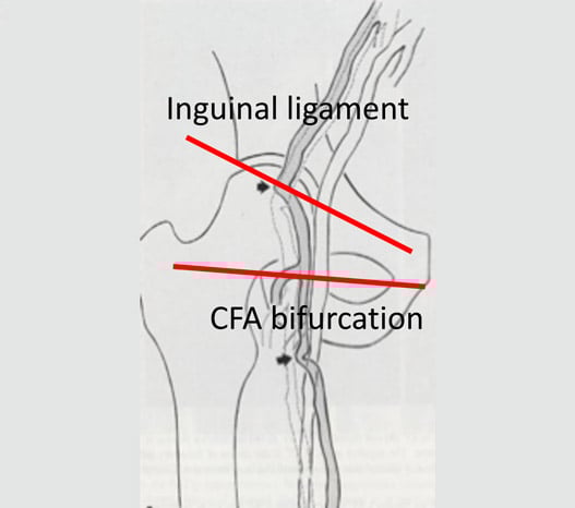Duplex scan guided puncture