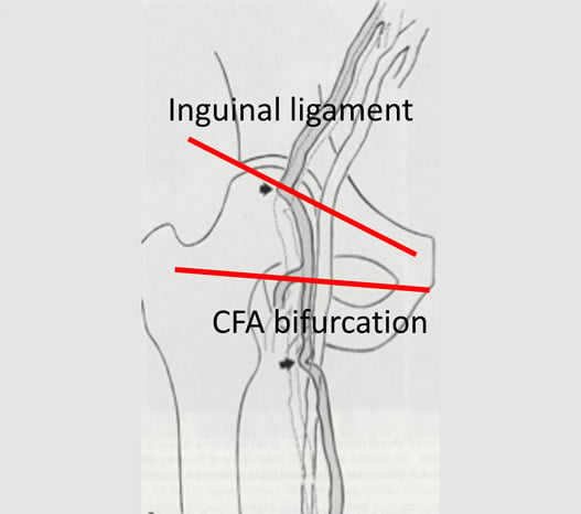 Duplex scan guided puncture