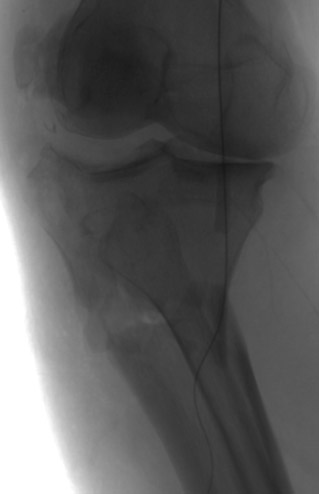 First angiography