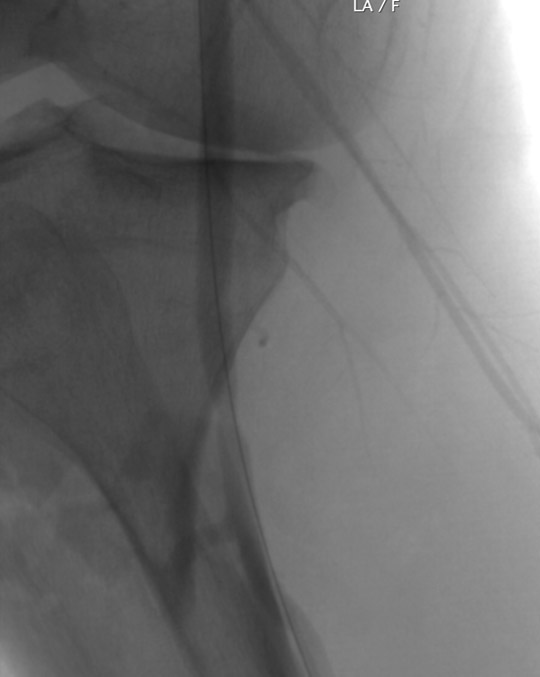 Second angiography