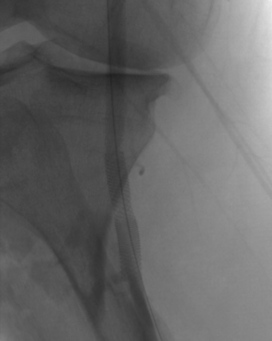 Stenting the dissected lesion with a SUPERA stent 