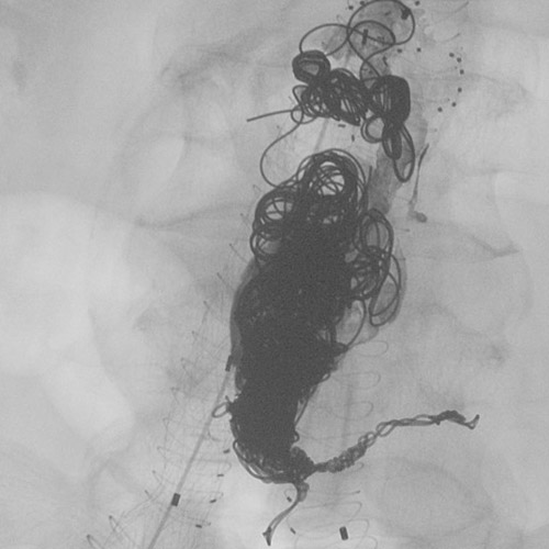 The Final Result with lumbar arteries + liquid space complete coiling and glue filling