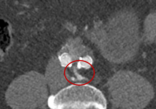Type 2 endoleak from sacro-lumbar arteries and AMI exit 