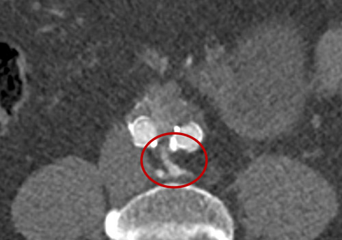 Type 2 endoleak from sacro-lumbar arteries and AMI exit