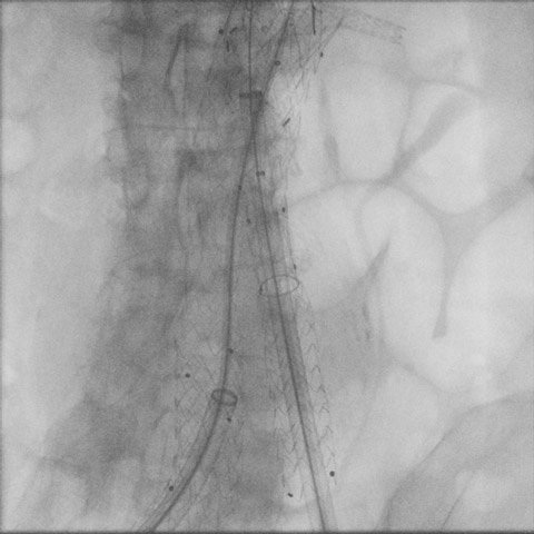 Leg adjunction on both sides for perfect exclusion and distal stability