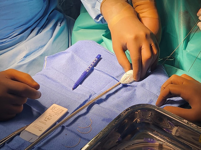 Stent-graft modification steps: Opening of the proximal part of the endograft with sufficiant length for fenestration shape