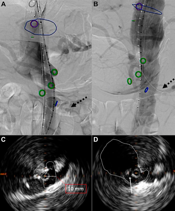 Figure 3. Static aortic angiography before septostomy and (B) after septostomy; to note paravisceral aortic lumen diameter increase and improved left renal artery perfusion (dotted arrow). (C) Static axial intravascular ultrasound (IVUS) image of the aortic true lumen (dotted line) and diameter (solid line) at the level of the superior mesenteric artery before septostomy and (D) after septostomy; to note the increased space of true lumen (dotted line) and the cut septum (solid arrow).