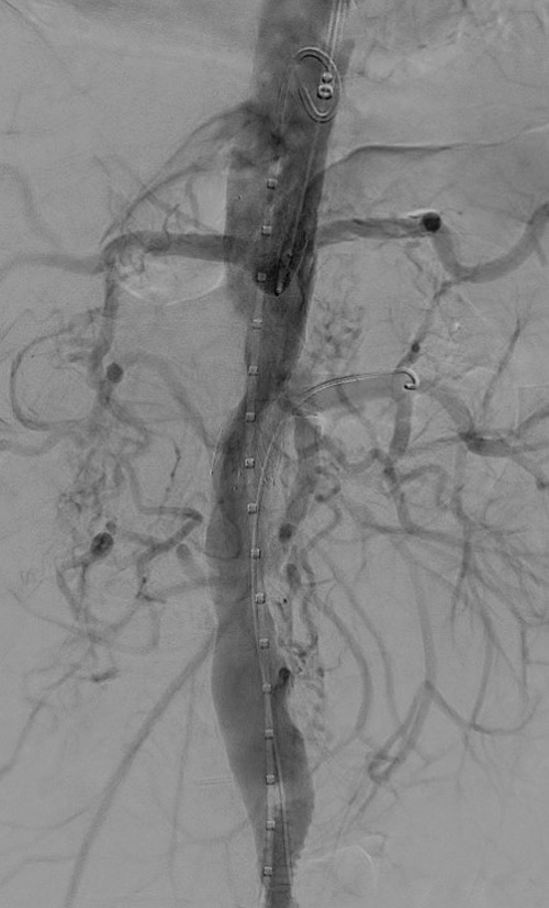 Angio: retrograde filling of SMA Good patency of aorta, celiac and renal artery