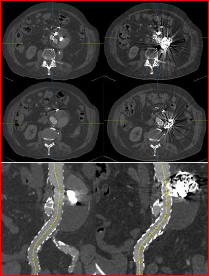 Postoperative period uneventfulwith no local or general complications