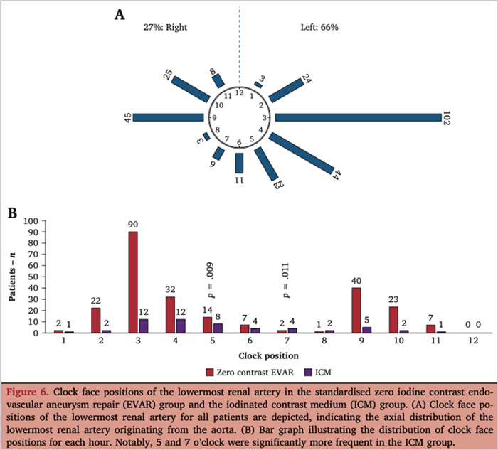 Feasibility and safety of using carbon dioxide exclusively in regular endovascular aortic aneurysm repair : results of a multicentre, prospective, zero iodine contrast endovascular aneurysm repair study