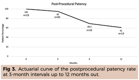 Figure 3: Popliteal access for iliofemoral occlusive disease in the office-based catheter laboratory