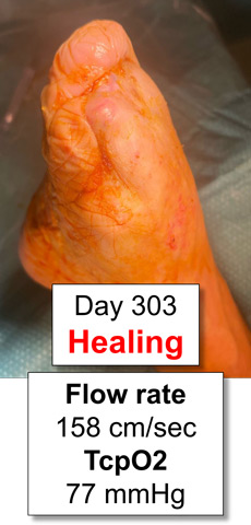Treatment for no-option CLTI patient: Day 303 Healing