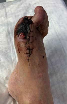 Treatment for no-option CLTI patient: Foot presentation