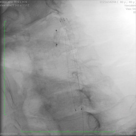 Angiogram control showing excellent result without residual stenosis 