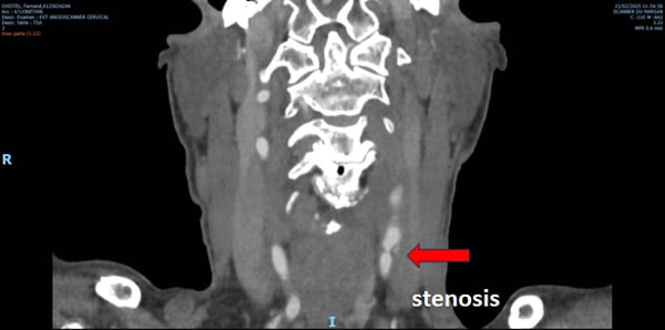 Unusual carotid enlargement after CEA