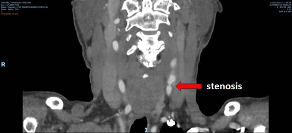 Unusual carotid enlargement after CEA