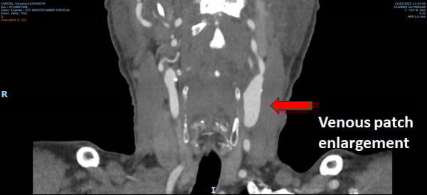 Unusual Carotid enlargement after CEA