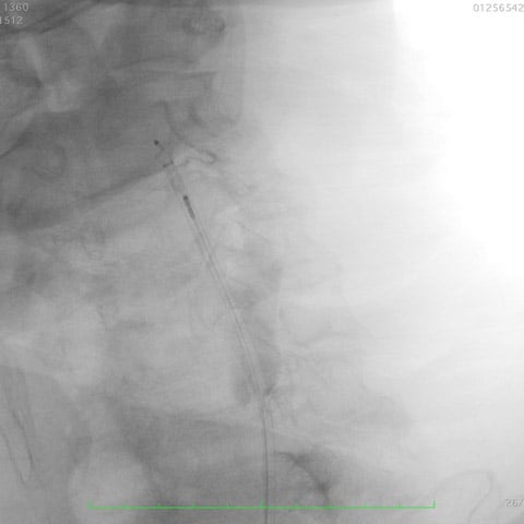 External carotid embolisation