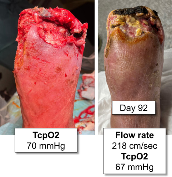 Treatment for no-option CLTI patient: Tension-free surgery