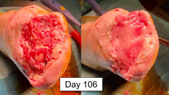 Treatment for no-option CLTI patient: Tension-free surgery
