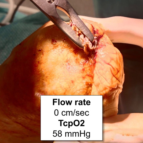 Treatment for no-option CLTI patient: Wound recurrence