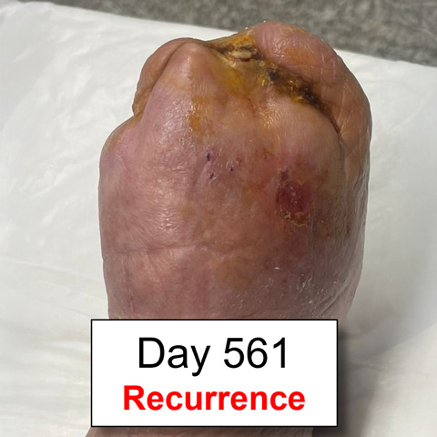 Treatment for no-option CLTI patient: Wound recurrence