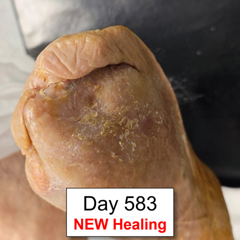 Treatment for no-option CLTI patient: Day 583 NEW Healing
