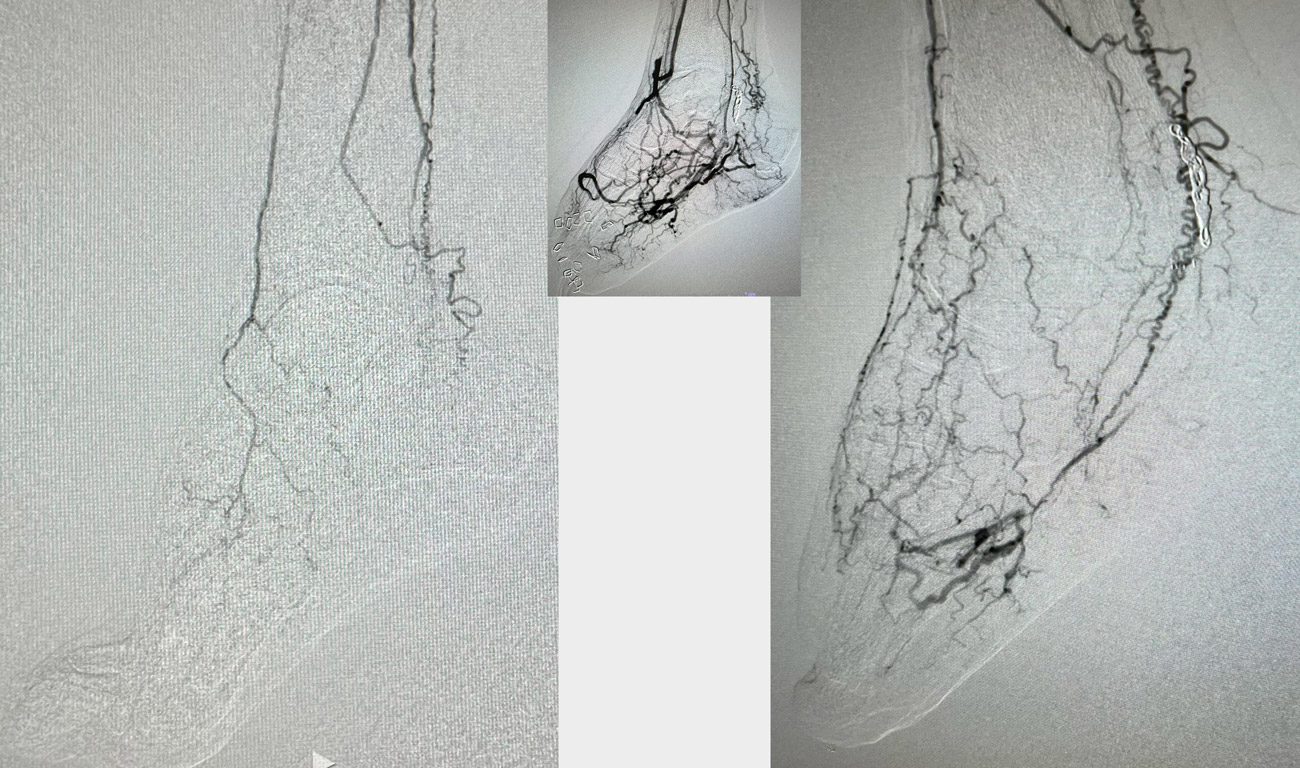 Treatment for no-option CLTI patient: Healing